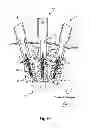 Fig. 07 - MODULAR PERCUTANEOUS SPINAL FUSION