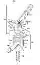 Fig. 01 - Percutaneous modular head-to-head cross connector