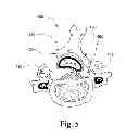 Fig. 05 - Laminoplasty devices and methods