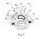 Fig. 07 - Laminoplasty devices and methods