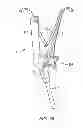 Fig. 17 - Instruments and methods for adjusting separation distance of vertebral bodies with a minimally invasive spinal stabilization procedure