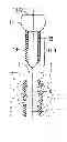 Fig. 01 - Method of anchoring an implant in tissue
