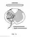 Fig. 35 - Charge-enhanced neural electric stimulation system