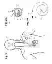Fig. 02 - Implantable neurostimulator-implemented method for managing tachyarrhythmia through vagus nerve stimulation