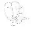 Fig. 12 - Cardiac stimulation using intravascularly-deliverable electrode assemblies