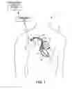 Fig. 02 - Capture threshold measurement for selection of pacing vector