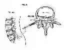 Fig. 07 - System and method for electrical stimulation of the lumbar vertebral column