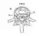 Fig. 09 - System and method for electrical stimulation of the lumbar vertebral column