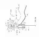 Fig. 07 - Method and Apparatus for Peritoneal Hypothermia and/or Resuscitation