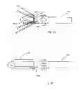 Fig. 11 - Methods of implanting a prosthesis and treating an aneurysm