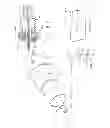 Fig. 09 - Methods of implanting a prosthesis