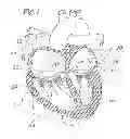 Fig. 02 - Device and method for reshaping tricuspid valve annulus