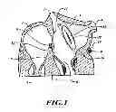 Fig. 02 - Method for anchoring a mitral valve