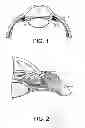 Fig. 02 - Flow promoting ocular implant