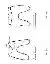Fig. 34 - Patient-adapted and improved articular implants, designs and related guide tools