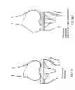 Fig. 37 - Patient-adapted and improved articular implants, designs and related guide tools