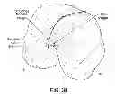 Fig. 49 - Patient-adapted and improved articular implants, designs and related guide tools
