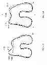 Fig. 53 - Patient-adapted and improved articular implants, designs and related guide tools