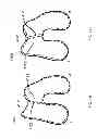 Fig. 55 - Patient-adapted and improved articular implants, designs and related guide tools