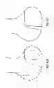 Fig. 72 - Patient-adapted and improved articular implants, designs and related guide tools