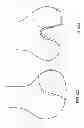 Fig. 74 - Patient-adapted and improved articular implants, designs and related guide tools