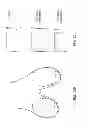Fig. 75 - Patient-adapted and improved articular implants, designs and related guide tools
