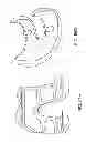 Fig. 79 - Patient-adapted and improved articular implants, designs and related guide tools