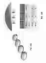 Fig. 86 - Patient-adapted and improved articular implants, designs and related guide tools