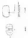 Fig. 99 - Patient-adapted and improved articular implants, designs and related guide tools