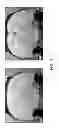 Fig. 02 - Functionalized magnetic nanoparticles and use in imaging amyloid deposits and neurofibrillary tangles