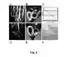 Fig. 09 - METHODS OF DIAGNOSING ATHEROSCLEROSIS BY MEASURING APOCI