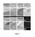 Fig. 10 - METHODS OF DIAGNOSING ATHEROSCLEROSIS BY MEASURING APOCI