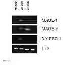 Fig. 06 - Allogeneic tumor cell vaccination