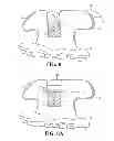 Fig. 05 - Self-ligating bracket with sliding cover