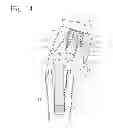 Fig. 12 - Keeper for implant and its assembly, and keeper-fixing method