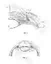Fig. 02 - Ocular implant delivery systems and methods
