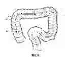 Fig. 09 - Multi-lumen-catheter retractor system for a minimally-invasive, operative gastrointestinal treatment