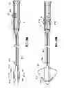 Fig. 22 - Multi-lumen-catheter retractor system for a minimally-invasive, operative gastrointestinal treatment