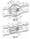 Fig. 23 - Multi-lumen-catheter retractor system for a minimally-invasive, operative gastrointestinal treatment