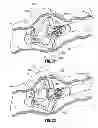 Fig. 24 - Multi-lumen-catheter retractor system for a minimally-invasive, operative gastrointestinal treatment