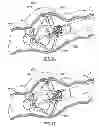 Fig. 25 - Multi-lumen-catheter retractor system for a minimally-invasive, operative gastrointestinal treatment