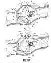 Fig. 26 - Multi-lumen-catheter retractor system for a minimally-invasive, operative gastrointestinal treatment
