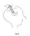 Fig. 07 - Flexible surgical sheath and multi-part insertion cannula