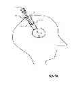 Fig. 08 - Flexible surgical sheath and multi-part insertion cannula