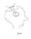 Fig. 09 - Flexible surgical sheath and multi-part insertion cannula
