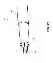 Fig. 31 - MULTIFUNCTIONAL GUIDEWIRE ASSEMBLIES AND SYSTEM FOR ANALYZING ANATOMICAL AND FUNCTIONAL PARAMETERS