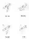 Fig. 92 - MULTIFUNCTIONAL GUIDEWIRE ASSEMBLIES AND SYSTEM FOR ANALYZING ANATOMICAL AND FUNCTIONAL PARAMETERS