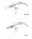 Fig. 95 - MULTIFUNCTIONAL GUIDEWIRE ASSEMBLIES AND SYSTEM FOR ANALYZING ANATOMICAL AND FUNCTIONAL PARAMETERS