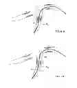 Fig. 98 - MULTIFUNCTIONAL GUIDEWIRE ASSEMBLIES AND SYSTEM FOR ANALYZING ANATOMICAL AND FUNCTIONAL PARAMETERS