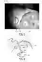 Fig. 05 - System and method for guided injection during endoscopic surgery